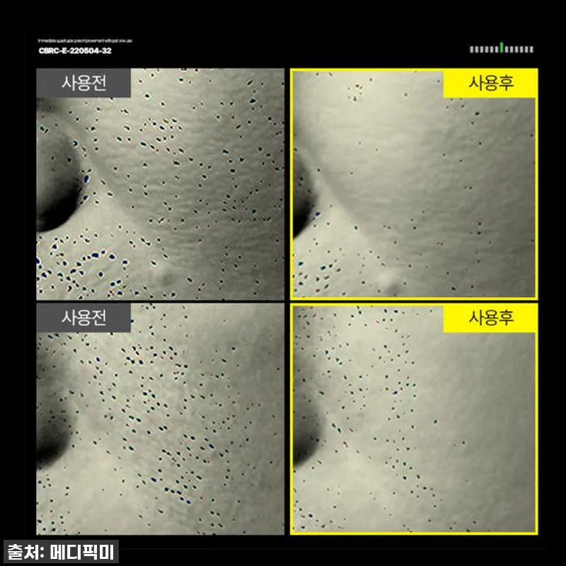 찐후기: 환절기 모공 고민 끝! 메디 관련 이미지 5